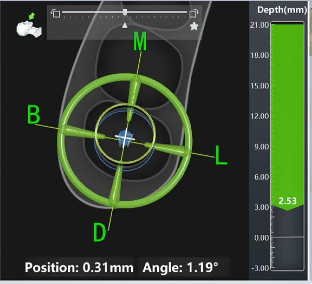 Ekran nawigacji dynamicznej DCARER: Position 0.31 mm, Angle 1.19°